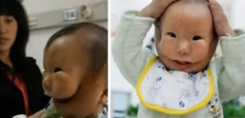 baby with rare condition transverse facial cleft